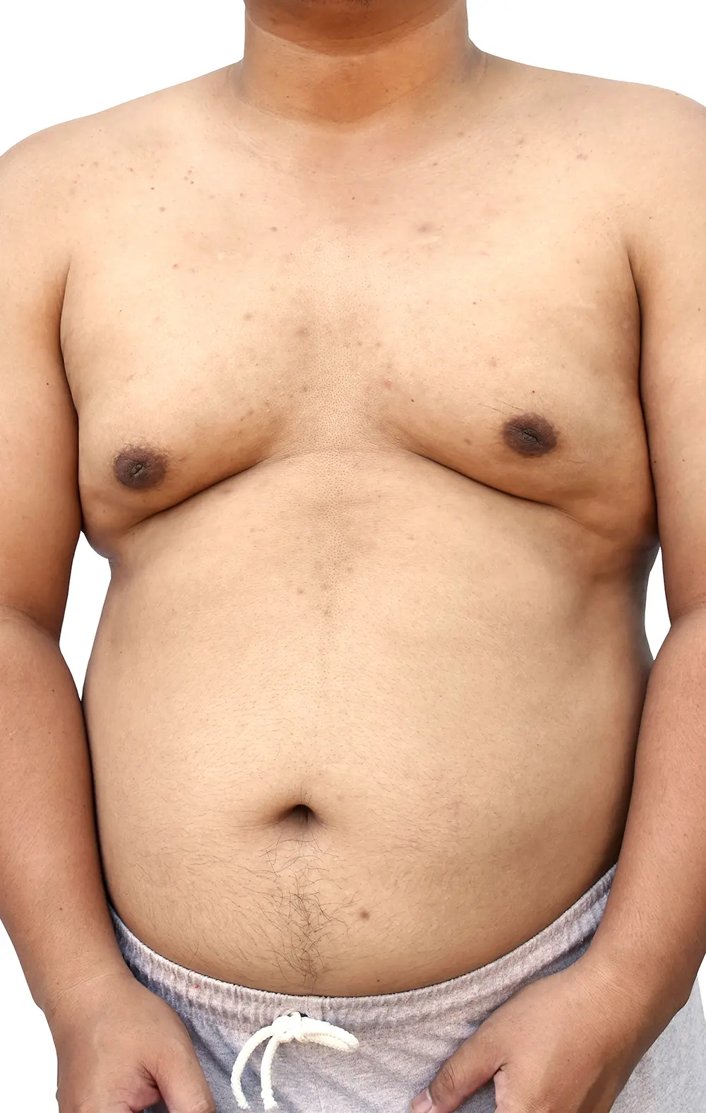 reduction-pectoraux-liposuccion Réduction des pectoraux par liposuccion