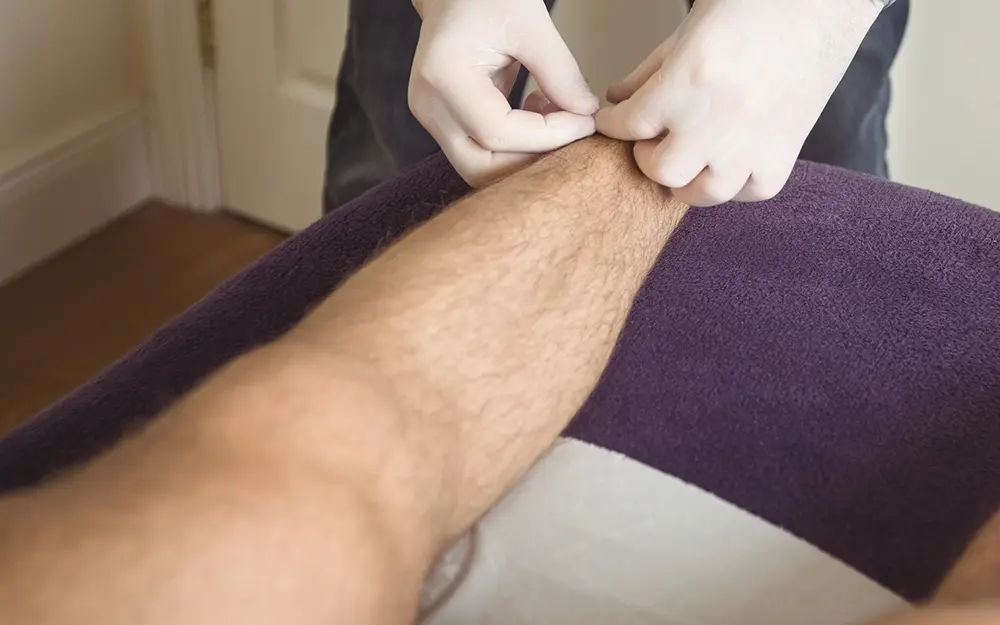 varices